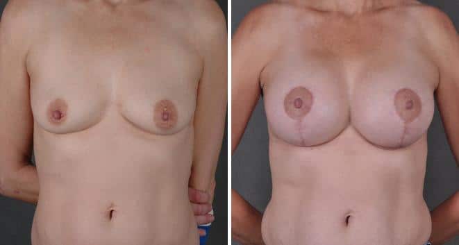 Breast Augmentation Before and After Photos in Omaha, NE, Case 4032