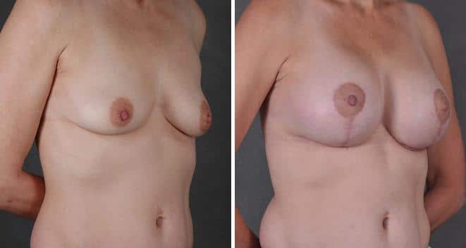 Breast Augmentation Before and After Photos in Omaha, NE, Case 4032