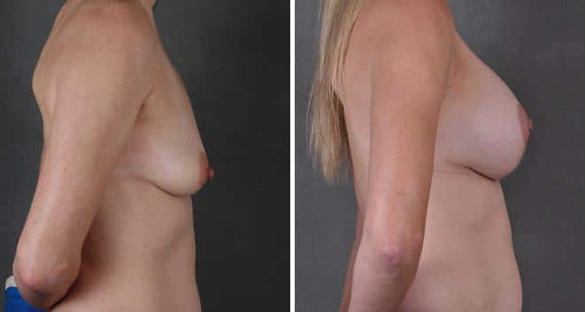 Breast Augmentation Before and After Photos in Omaha, NE, Case 4032