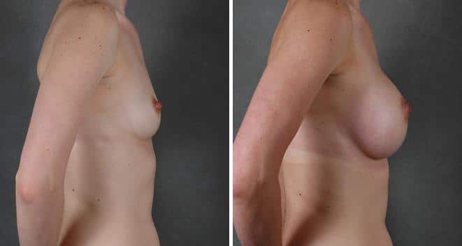 Breast Augmentation Before and After Photos in Omaha, NE, Case 3881