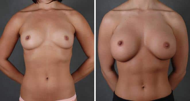 Breast Augmentation Before and After Photos in Omaha, NE, Case 3888