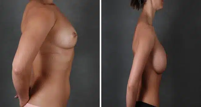 Breast Augmentation Before and After Photos in Omaha, NE, Case 3888