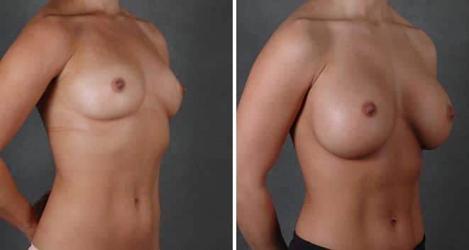 Breast Augmentation Before and After Photos in Omaha, NE, Case 3888