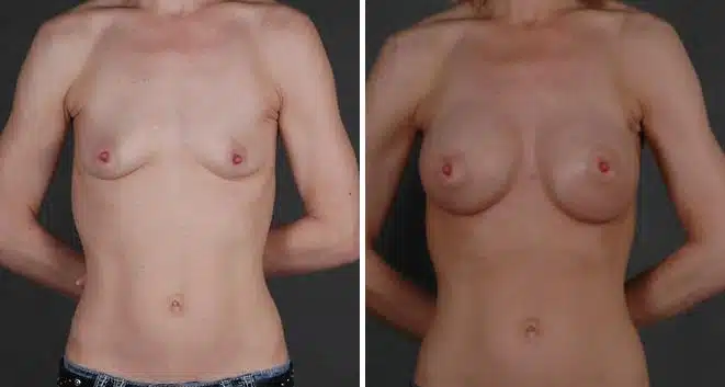 Breast Augmentation Before and After Photos in Omaha, NE, Case 3866