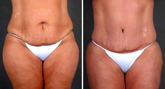 Liposuction Before and After Photos in Omaha, NE, Case 4057