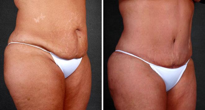 Liposuction Before and After Photos in Omaha, NE, Case 4057