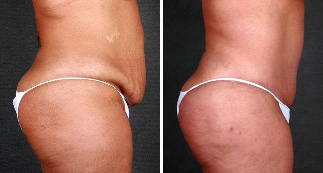 Liposuction Before and After Photos in Omaha, NE, Case 4057