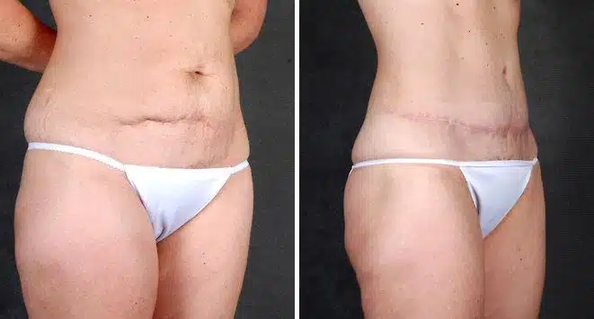 Liposuction Before and After Photos in Omaha, NE, Case 4078