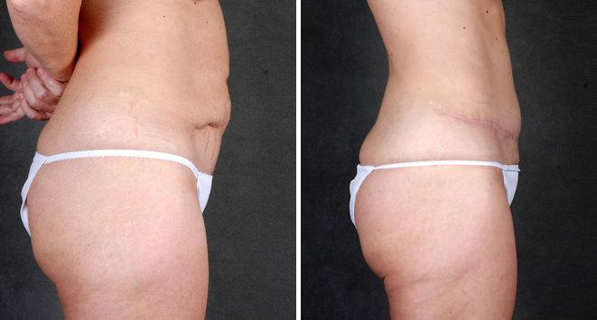 Liposuction Before and After Photos in Omaha, NE, Case 4078