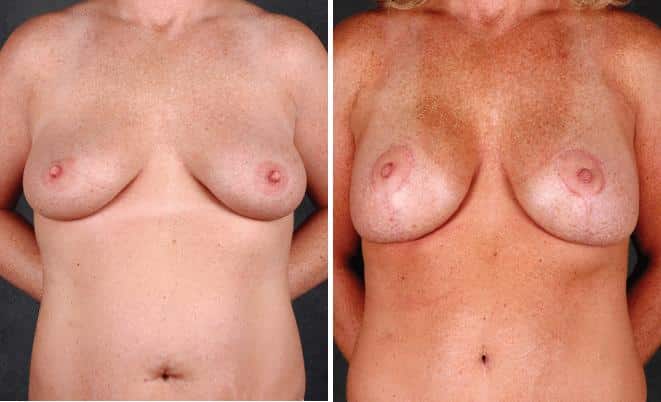 Liposuction Before and After Photos in Omaha, NE, Case 4086