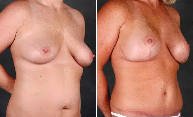 Liposuction Before and After Photos in Omaha, NE, Case 4086