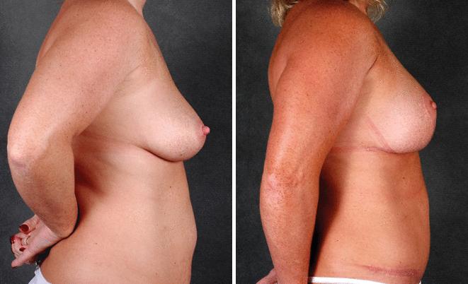 Liposuction Before and After Photos in Omaha, NE, Case 4086