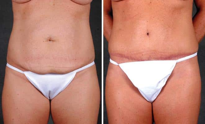 Liposuction Before and After Photos in Omaha, NE, Case 4086