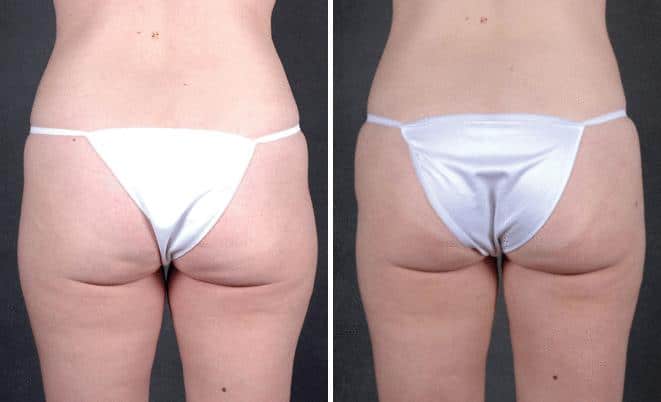 Liposuction Before and After Photos in Omaha, NE, Case 4012