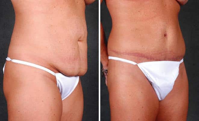 Liposuction Before and After Photos in Omaha, NE, Case 4086