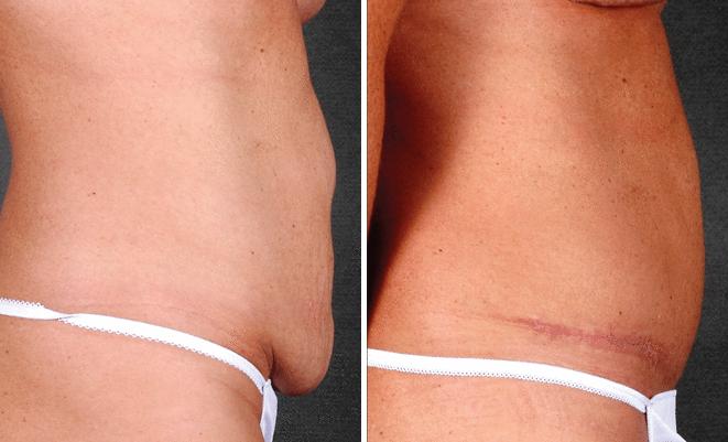 Liposuction Before and After Photos in Omaha, NE, Case 4086