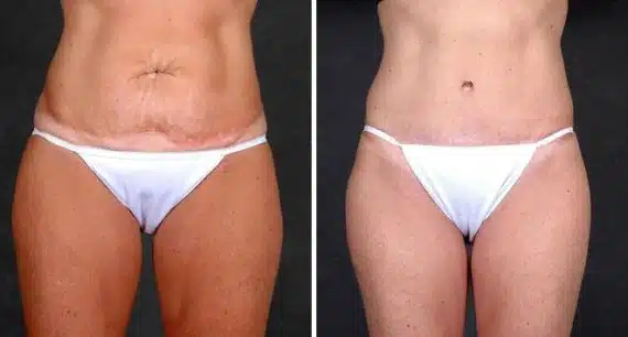 Liposuction Before and After Photos in Omaha, NE, Case 4104