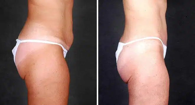 Liposuction Before and After Photos in Omaha, NE, Case 4104