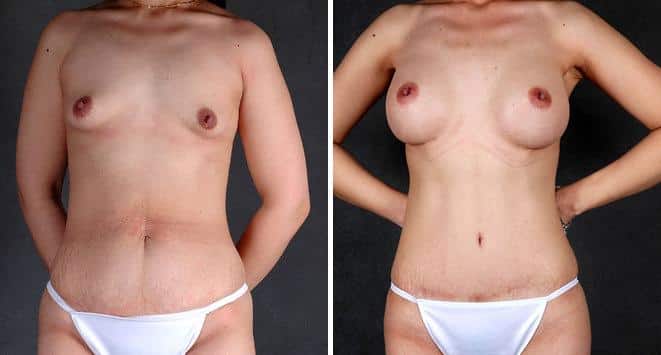 Liposuction Before and After Photos in Omaha, NE, Case 4115