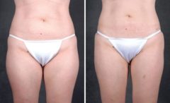 Liposuction Before and After Photos in Omaha, NE, Case 4012