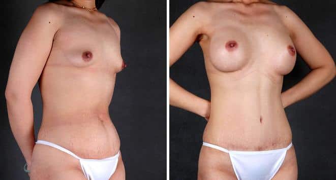 Liposuction Before and After Photos in Omaha, NE, Case 4115