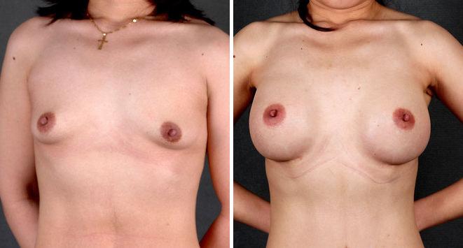 Liposuction Before and After Photos in Omaha, NE, Case 4115