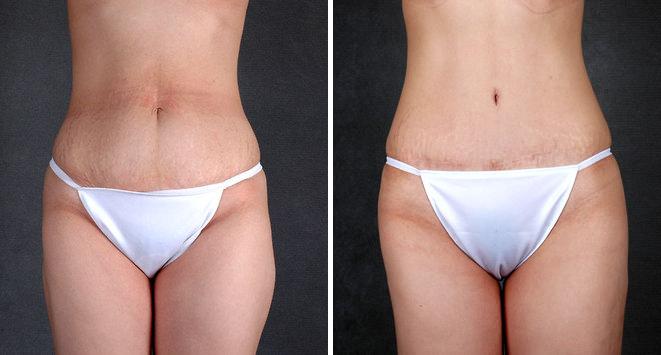 Liposuction Before and After Photos in Omaha, NE, Case 4115