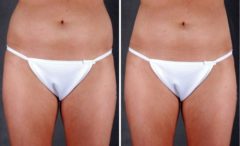 Liposuction Before and After Photos in Omaha, NE, Case 4039