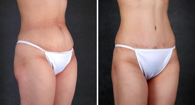 Liposuction Before and After Photos in Omaha, NE, Case 4115