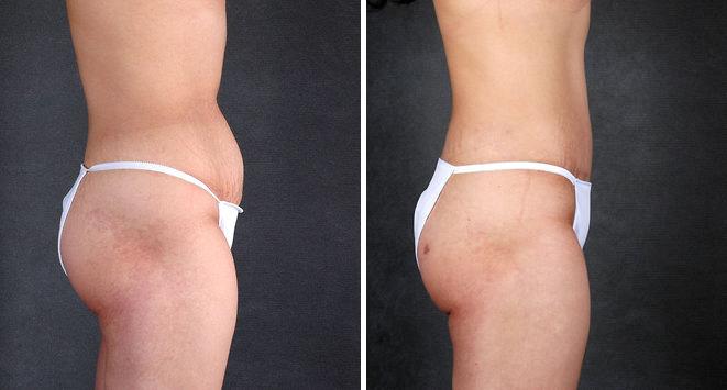 Liposuction Before and After Photos in Omaha, NE, Case 4115