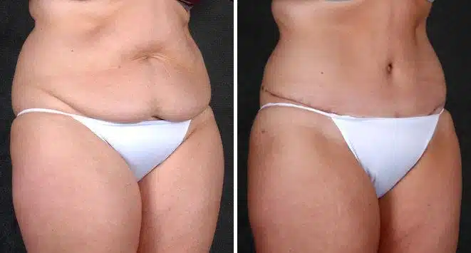 Liposuction Before and After Photos in Omaha, NE, Case 4139