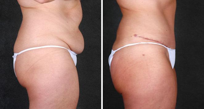 Liposuction Before and After Photos in Omaha, NE, Case 4139