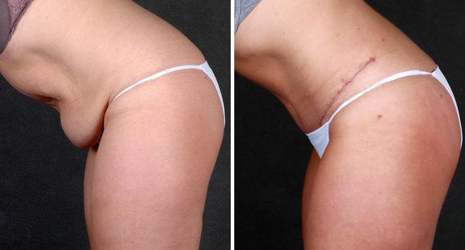 Liposuction Before and After Photos in Omaha, NE, Case 4139