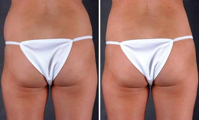 Liposuction Before and After Photos in Omaha, NE, Case 4039
