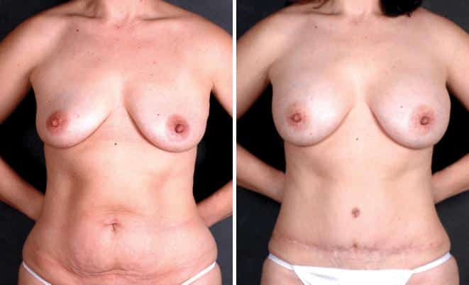 Liposuction Before and After Photos in Omaha, NE, Case 4045