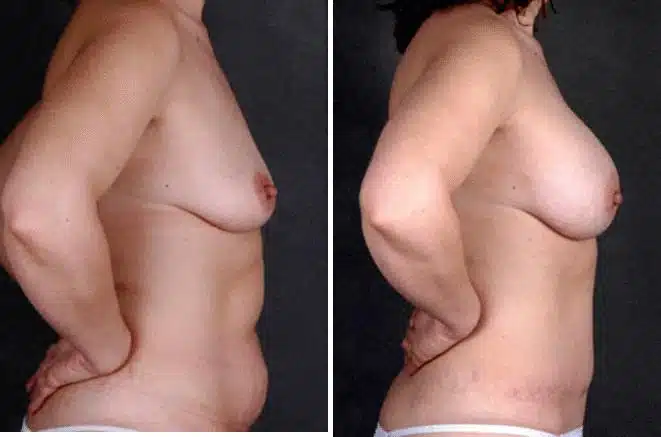 Liposuction Before and After Photos in Omaha, NE, Case 4045