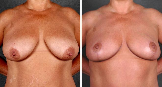 Liposuction Before and After Photos in Omaha, NE, Case 4057