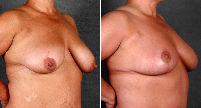 Liposuction Before and After Photos in Omaha, NE, Case 4057