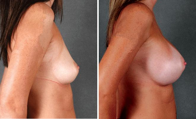 Breast Augmentation Before and After Photos in Omaha, NE, Case 4128