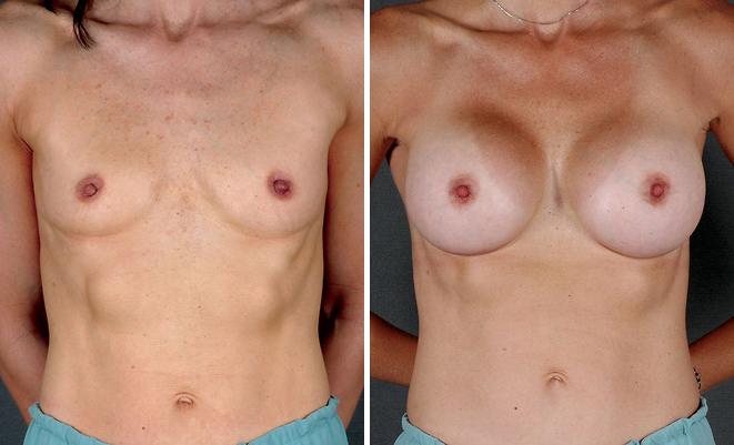 Breast Augmentation Before and After Photos in Omaha, NE, Case 4140