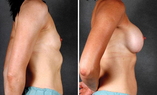 Breast Augmentation Before and After Photos in Omaha, NE, Case 4140