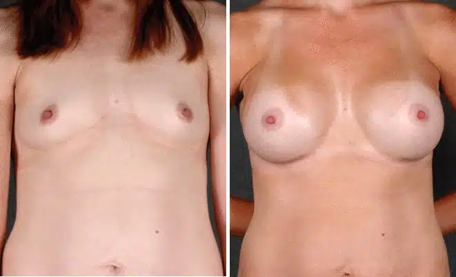 Breast Augmentation Before and After Photos in Omaha, NE, Case 4160