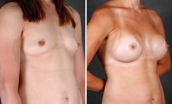 Breast Augmentation Before and After Photos in Omaha, NE, Case 4160