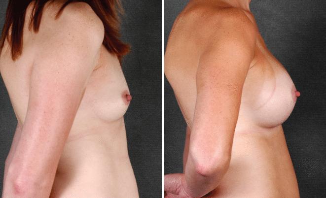 Breast Augmentation Before and After Photos in Omaha, NE, Case 4160