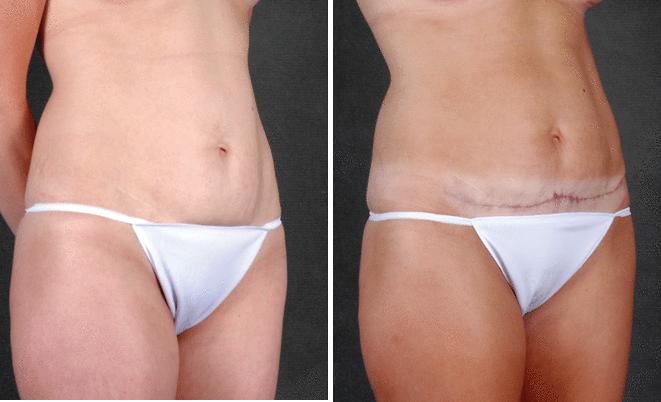 Breast Augmentation Before and After Photos in Omaha, NE, Case 4160