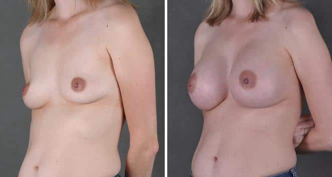 Breast Augmentation Before and After Photos in Omaha, NE, Case 4056