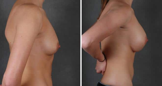 Breast Augmentation Before and After Photos in Omaha, NE, Case 4174