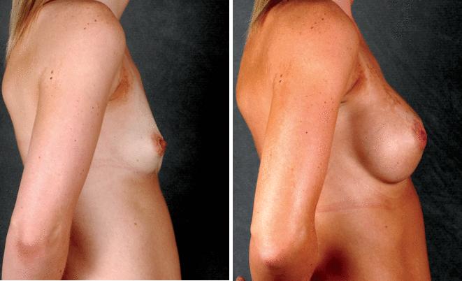 Breast Augmentation Before and After Photos in Omaha, NE, Case 4198