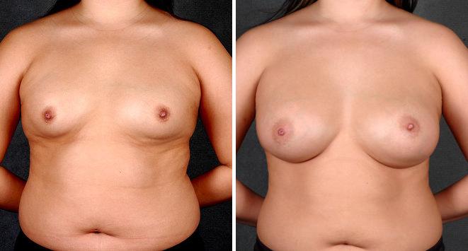 Breast Augmentation Before and After Photos in Omaha, NE, Case 4225