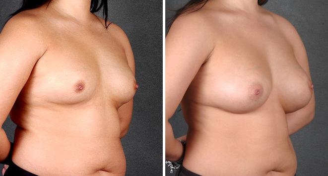 Breast Augmentation Before and After Photos in Omaha, NE, Case 4225